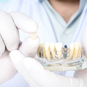 dentist holding up a model of an implant-retained crown