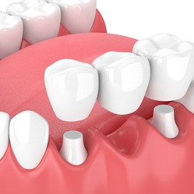 dental bridge