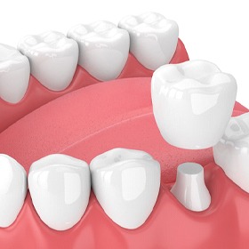 model of dental crown