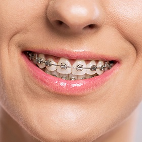 Closeup of smile with braces