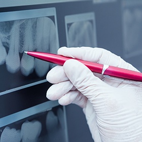 Pen pointing to digital dental x-rays