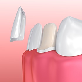 Animation of porcelain veneer placement