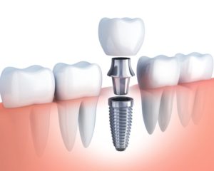 A model of a dental implant. 